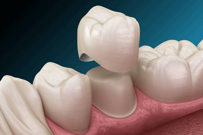 Corona dental colocándose sobre un diente preparado