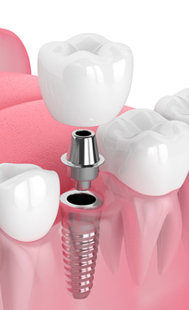 Implante dental, pilar y corona colocados entre dientes naturales